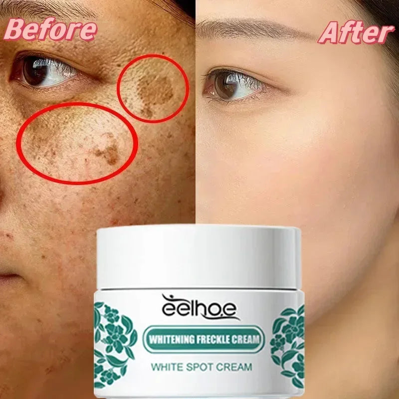 Niacinamide Dark Spot & Freckle Remover Cream